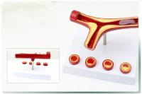 心血管动脉硬化模型