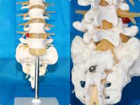 腰椎带马尾神经