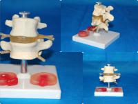 腰椎带病变椎间盘模型 