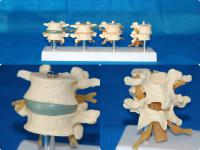 腰椎随年龄病变 