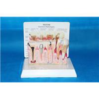 牙齿病理模型 