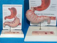 桌上型胃溃疡带不同深度层解 