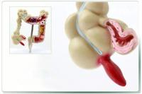 人体结肠病变模型