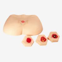 阶段褥疮护理模型 